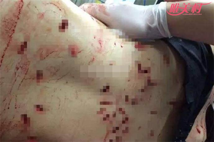 郑州女子遭报复被刺66刀