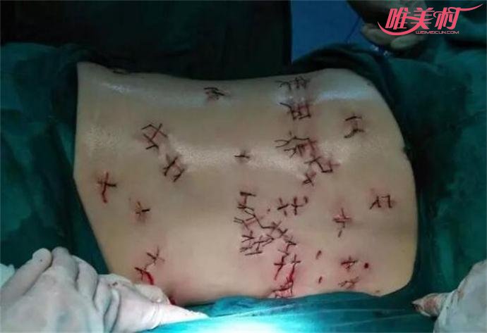 郑州女子遭报复被刺66刀后被缝了很多针