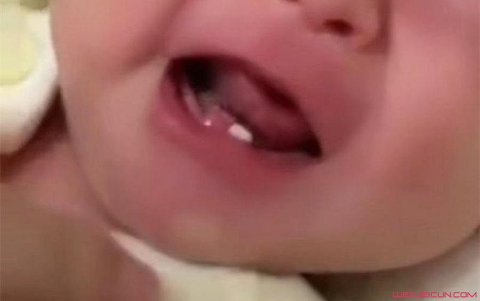 女婴出生长两颗牙