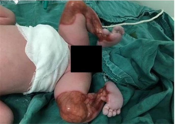 新生儿双腿透明 高危罕见病例最终痊愈出院