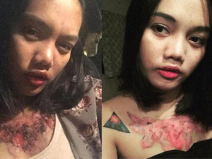女学生除纹身被坑留疤痕 胸前皮肤坏死腐烂