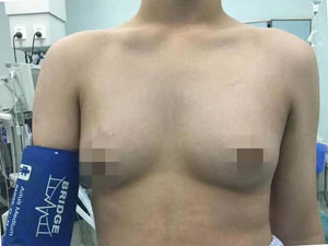 小伙胸围达115厘米 拥有女孩的乳房是隆胸了