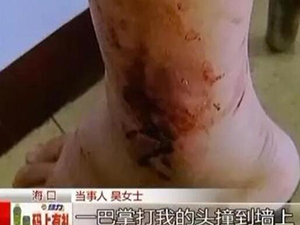 女子遭轮流殴打 腿险被砍断身上多处伤痕事