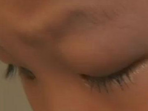 男童眼中发现电池 碱性物质使得眼内组织烧